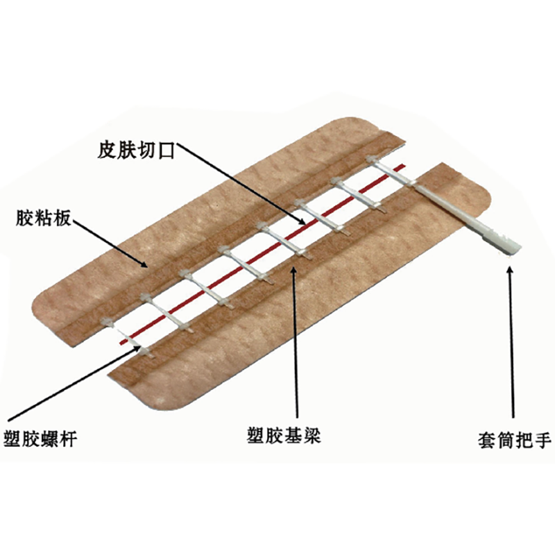 一次性使用免缝闭合器 ZHQ-125