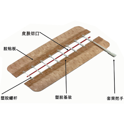 一次性使用免缝闭合器 ZHQ-125