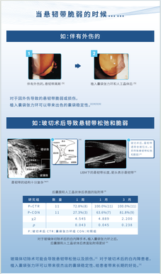 威朗 预装式张力环 ACPi-11